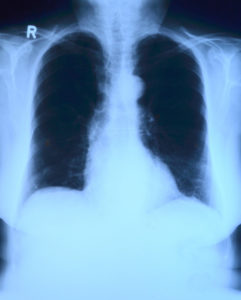 chest x-ray in lucid dreaming